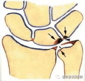 尺骨撞击症认定工伤