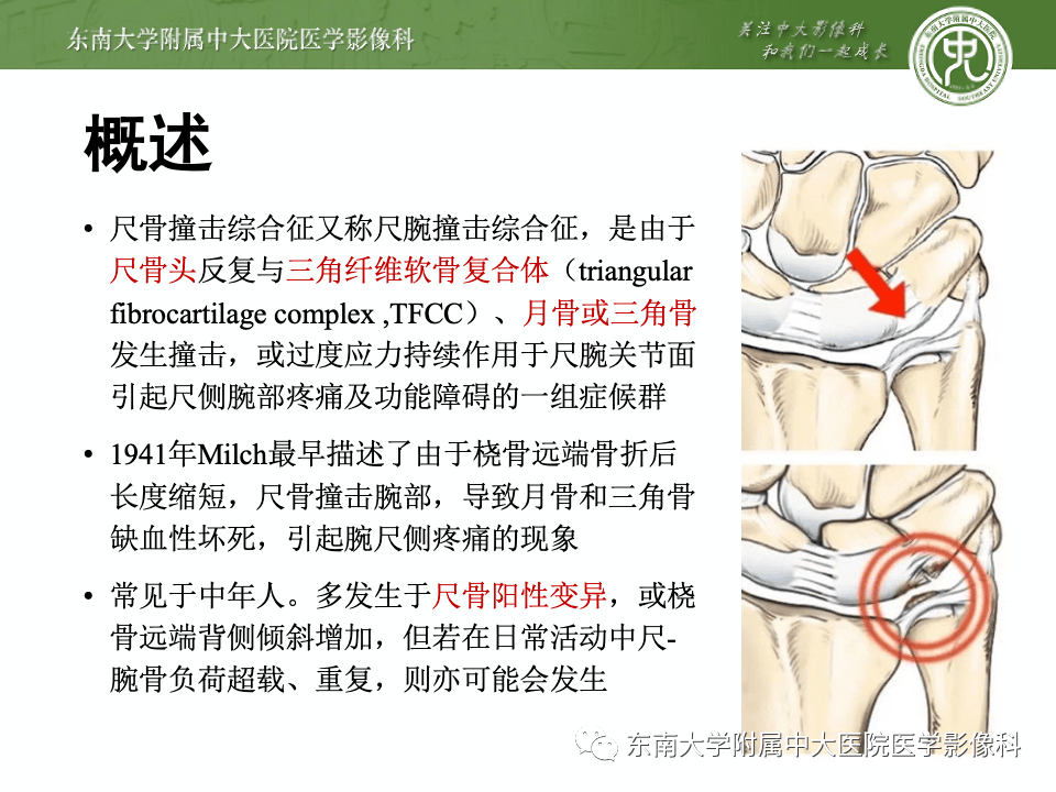 尺骨撞击症认定工伤