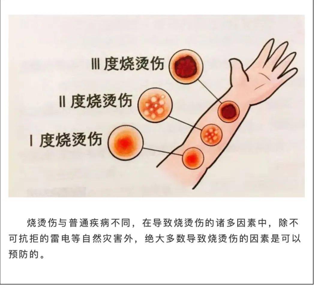 工作中遭遇烫伤事故：原因分析、处理方法及预防措