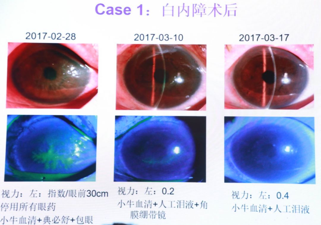 角膜上皮脱落是否构成轻微伤害级别