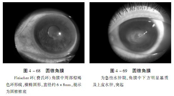 眼角膜上皮剥脱病情严重性评估：需警惕的严重症状》