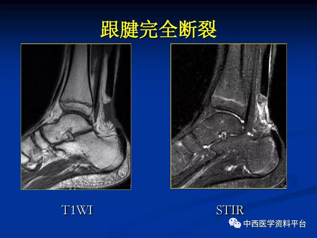 踝关节扭伤：诊断、治疗与复指南