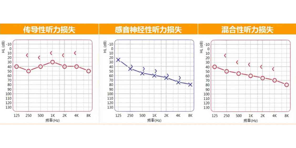 纯音测听报告ai正常