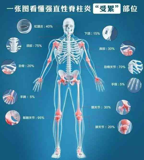 强制性脊柱炎能不能评残及残疾等级评定标准