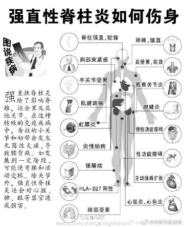 强制性脊柱炎能认定工伤吗