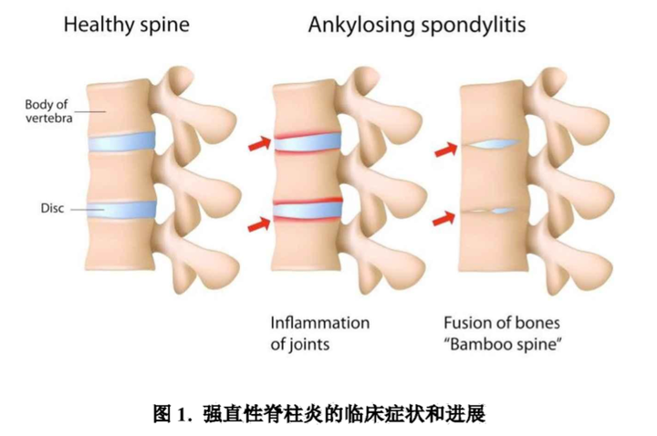 强直性脊柱炎能否认定工伤等级及伤残评定，是否属于工伤或职业病