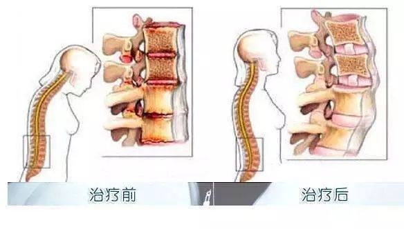 强直性脊柱炎：能否作为职业性疾病进行工伤认定？