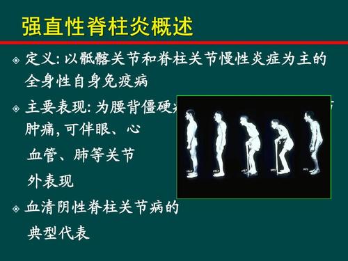 强直性脊柱炎患者能否依据公务性质申请评残鉴定