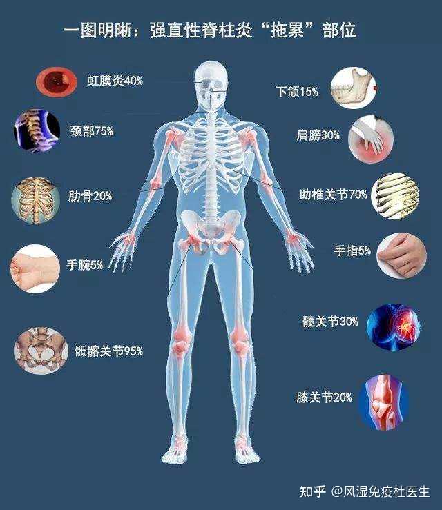 强直性脊柱炎是工伤还是职业病：能否申请工伤认定及分类讨论