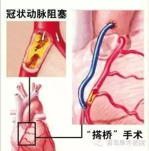 心脏支架能认定工伤吗多少钱？包括手术费用及每月治疗费用解析