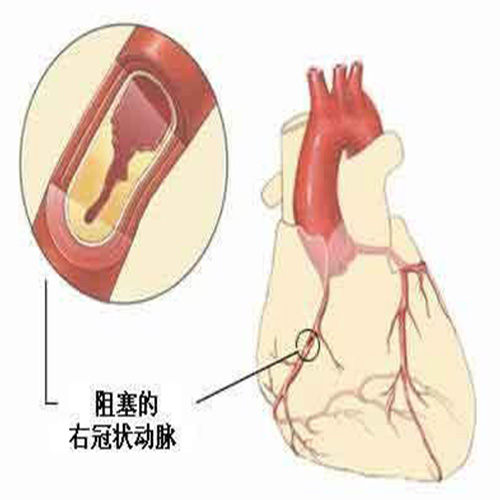 心脏支架能认定工伤吗多少钱？包括手术费用及每月治疗费用解析