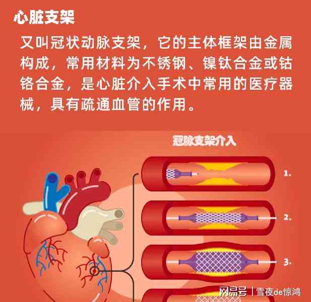 工伤认定：心脏支架手术能否纳入工伤补偿范畴