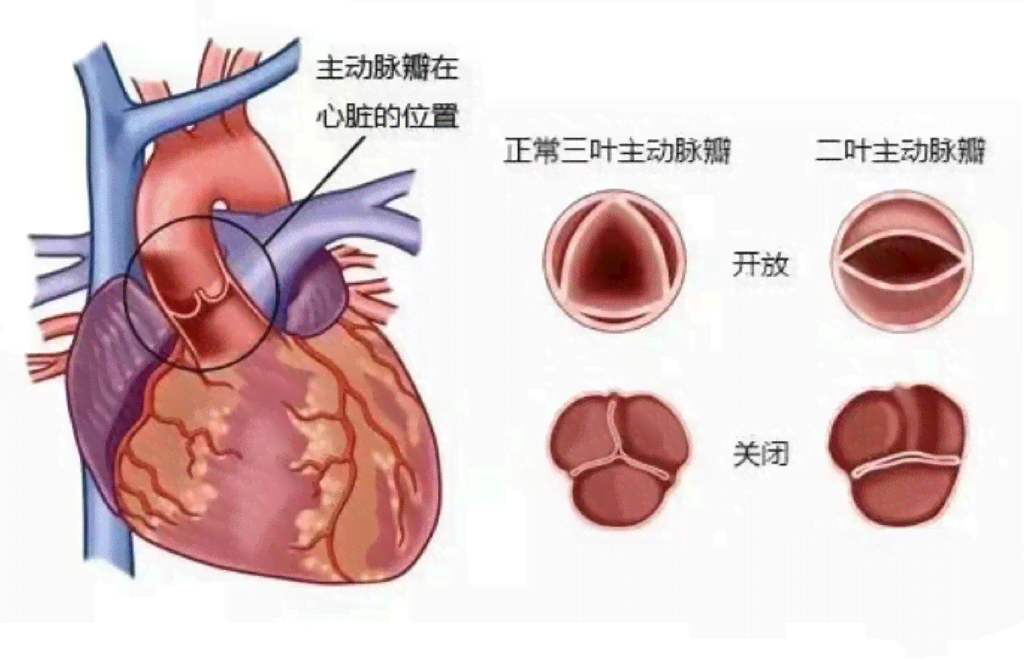 心脏病做手术能否完全复、手术费用及风险详解