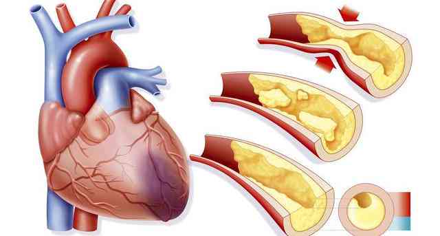 心血管塞算心脏病吗：严重性、治疗与是否属于心梗详解
