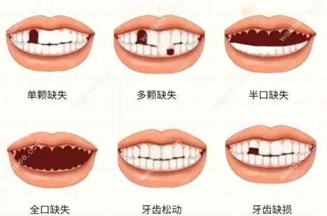 工伤认定新标准：牙齿脱落能否被纳入工伤范畴？