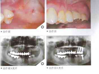 牙齿摔断一半如何修复？探讨各类断裂牙齿的补救方法与治疗选择