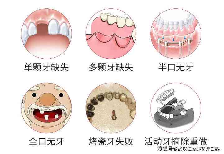 牙齿缺失工伤认定标准及赔偿流程详解：包含赔偿项目、金额与法律依据