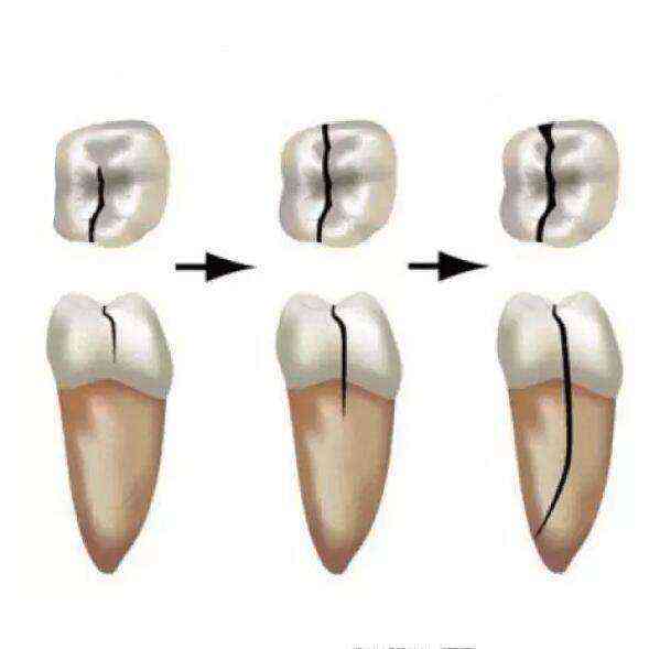 牙齿裂纹修复指南：探讨裂纹牙齿的修补方法与技巧