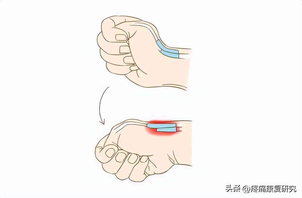 狭窄性腱鞘炎患者如何合理安排日常劳动与活动：预防与应对策略全解析