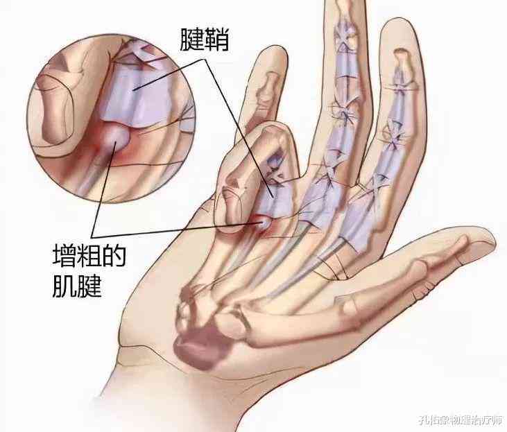 得了狭窄性腱鞘炎还能干重活吗：女性患者能否从事重体力劳动？