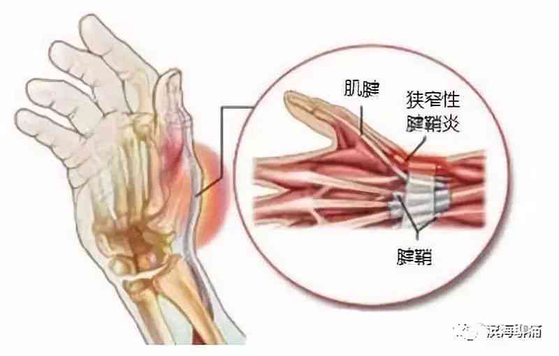 狭窄性腱鞘炎能认定工伤