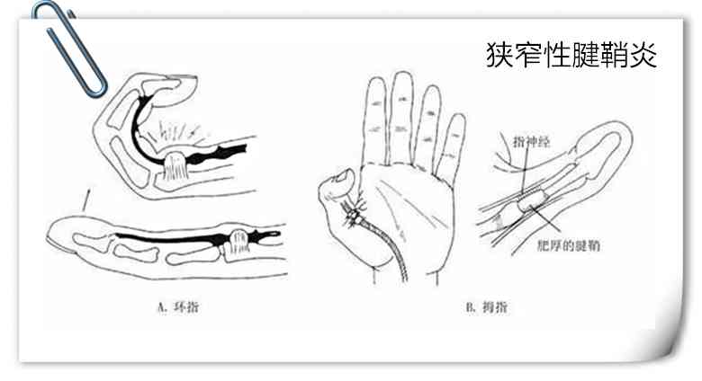 狭窄性腱鞘炎能认定工伤