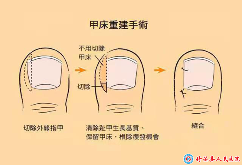 甲沟炎是否可认定为工伤及工伤赔偿标准解析