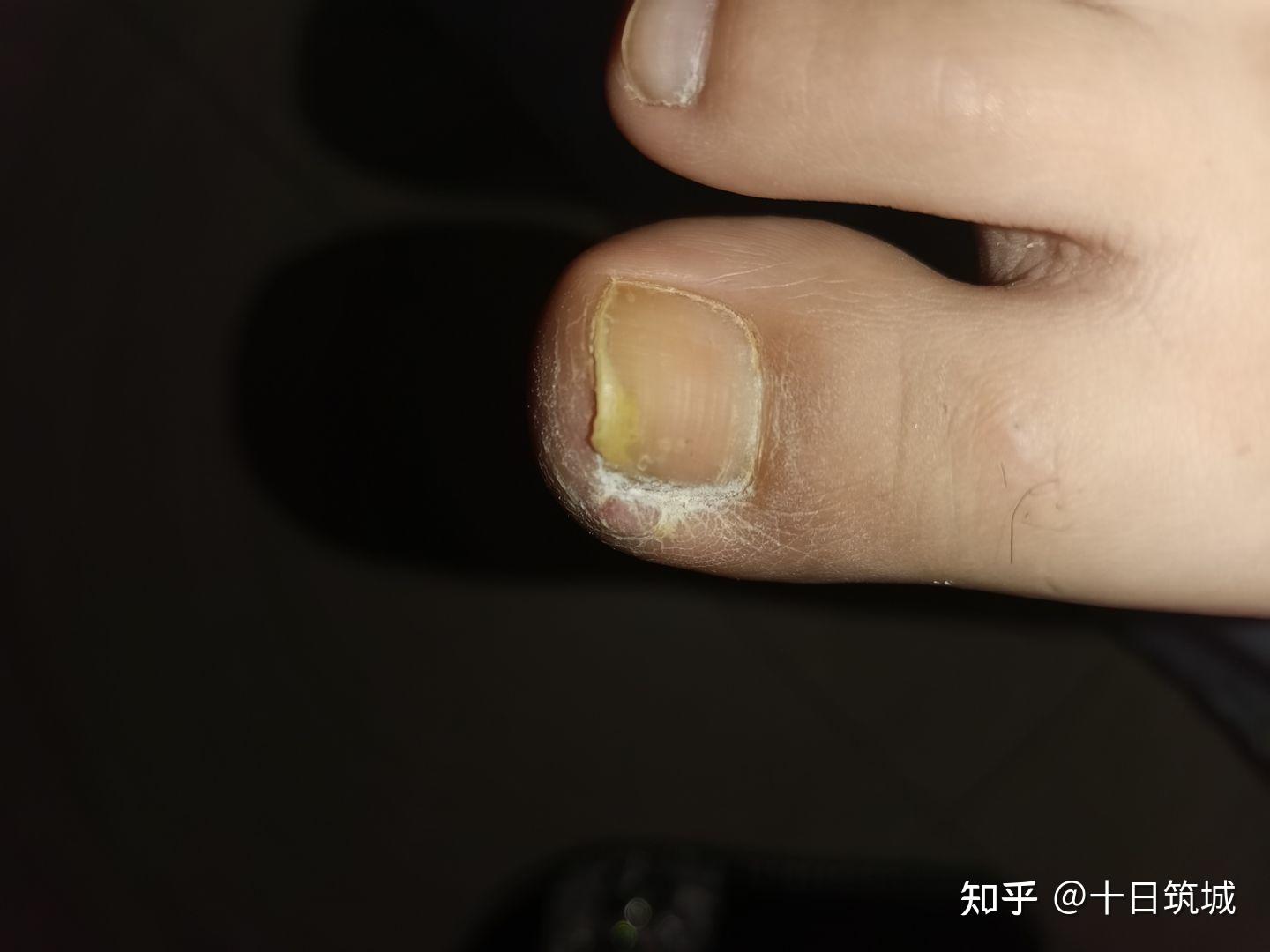 甲沟炎能否被认定为工伤：常见疑问与详细解答