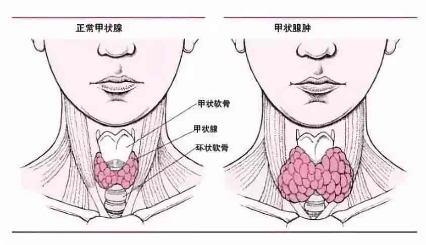 甲状腺癌可以认定工伤吗