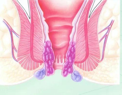 同步治疗：痔疮与肛裂联合手术可行性探讨