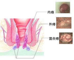 同步治疗：痔疮与肛裂联合手术可行性探讨