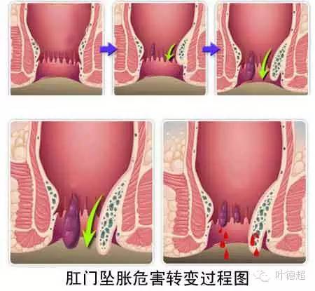 同步治疗：痔疮与肛裂联合手术可行性探讨