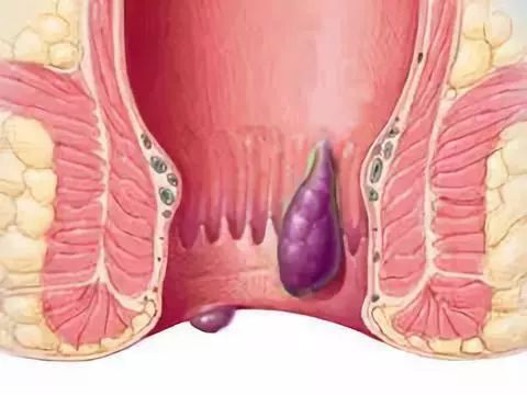 同步治疗：痔疮与肛裂联合手术可行性探讨
