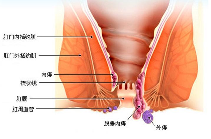 同步治疗：痔疮与肛裂联合手术可行性探讨