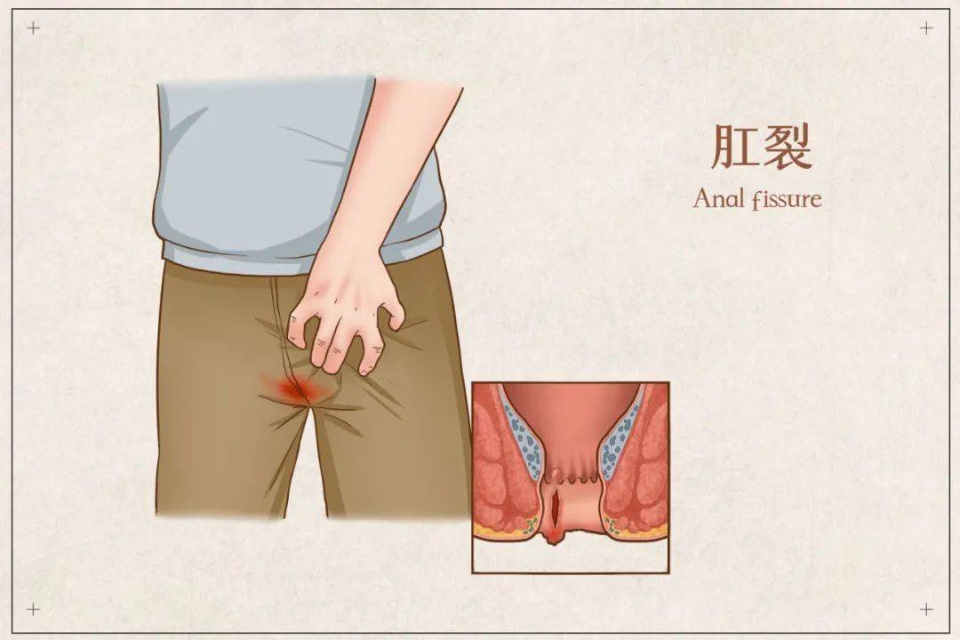 全面解析痔疮与肛裂：成因、症状、预防和治疗全攻略