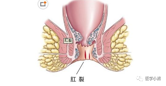 痔疮合并肛裂：探讨综合治疗方案与治愈可能性