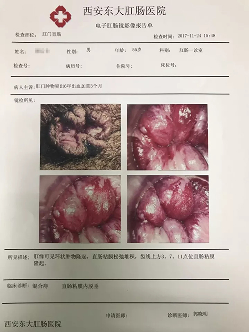 痔疮合并肛裂：探讨综合治疗方案与治愈可能性