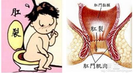 痔疮合并肛裂：探讨综合治疗方案与治愈可能性