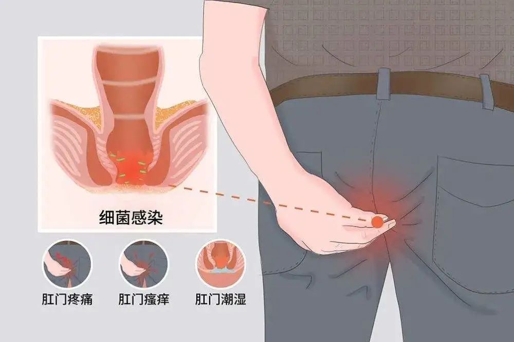 痔疮、肛裂及其癌变风险：全面解析与预防指南