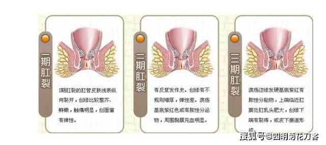 痔疮、肛裂及其癌变风险：全面解析与预防指南