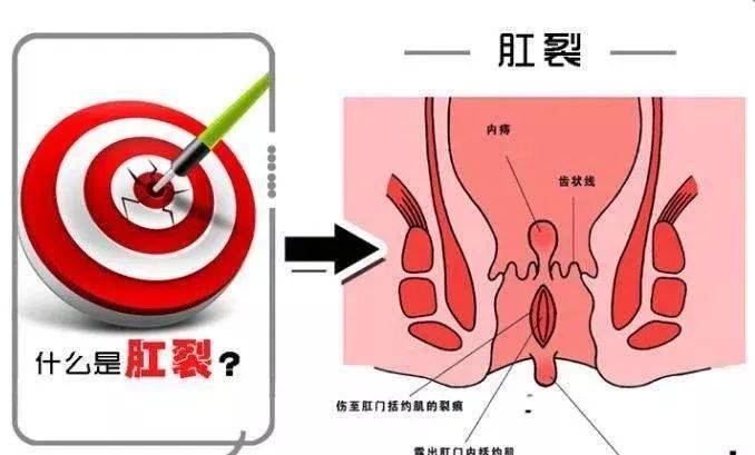 痔疮、肛裂及其癌变风险：全面解析与预防指南