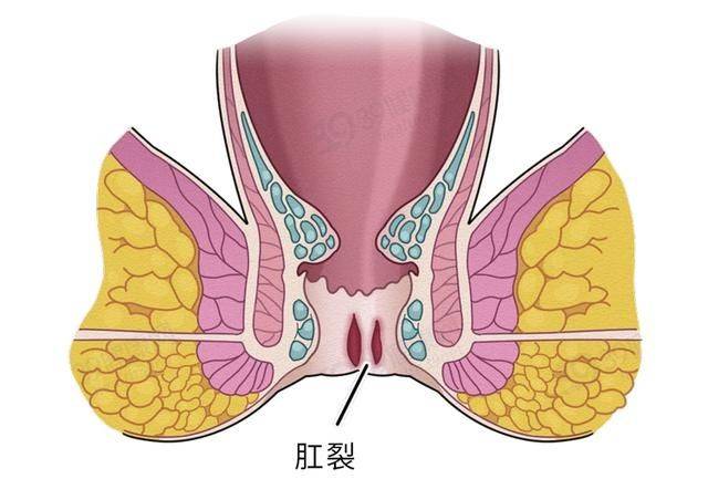 痔疮、肛裂及其癌变风险：全面解析与预防指南