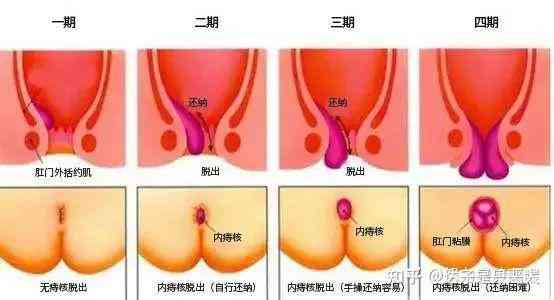 痔疮和肛裂能认定工伤吗