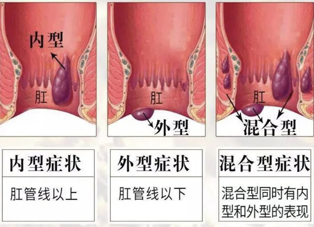 痔疮算不算残疾：痔疮能否定义为残疾人患者及残疾性质探讨