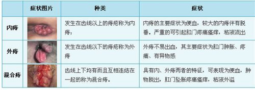 痔疮症状能否作为认定工伤的依据