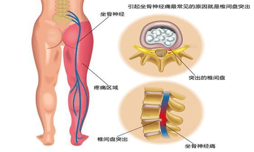 皮质扭曲：探究其属于的骨折类型与临床意义