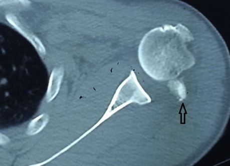 盂肱关节半脱位由什么造成：典型体征、多发生情况及前脱位分析