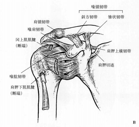 盂肱关节脱位常见于哪些情况？