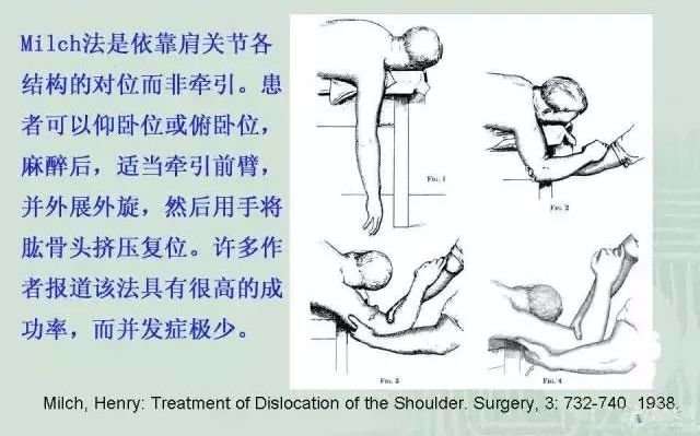 肱关节脱位：典型体征、手法复位与高发原因概述