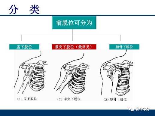 肱关节脱位：典型体征、手法复位与高发原因概述